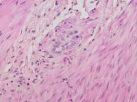 Immaturity of Myenteric Plexus