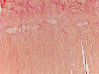 Desmosis coli II x100